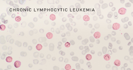 Gilead Sciences Leukemie Schema
